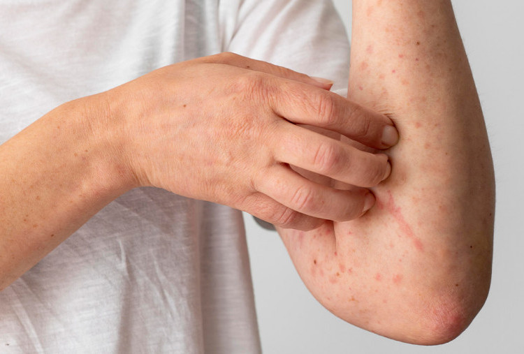 Kemenkes Pastikan Campak Terkendali, Pelacakan Kontak Diperketat 