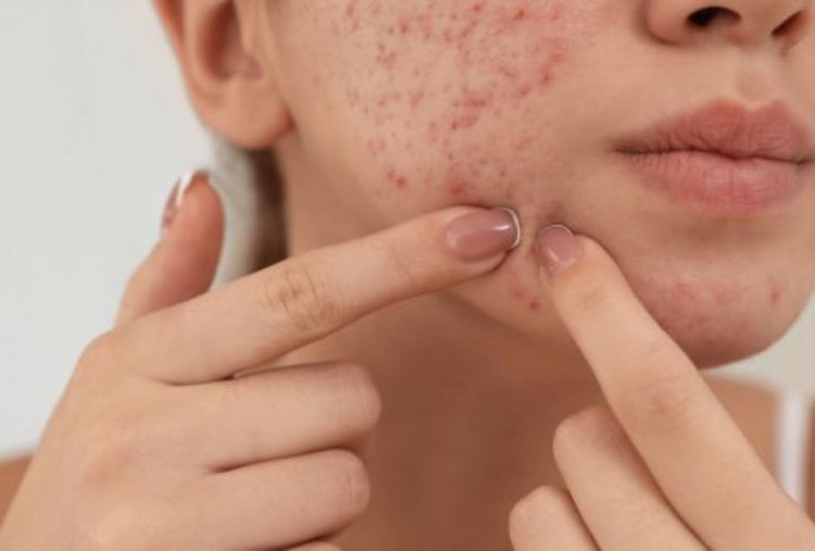 5 Tip Mengatasi Jerawat Hormonal Akibat Begadang dan Stres