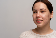 5 Cara Mengatasi Noda Hitam di Wajah yang Bikin Tak Percaya Diri, Dijamin Ampuh dan Efektif!