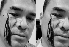Penampakan Wajah Bro Ron Usai Dipukuli 2 Preman, Darah Mengucur di Pelipis Mata