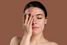 Jerawat Muncul Jangan Dipencet, Pakai B ERL Very Berry Acne Spot Treatment