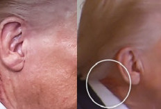 Di Leher Trump Muncul Bercak-Bercak Merah, Sakit Apa? Dokter Kepresidenan Gedung Putih Buka Suara