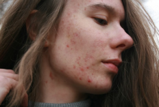 Cara Aman Atasi Jerawat Tanpa Iritasi, Rutin Pakai Bisa Kasih Dampak Besar