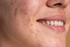 5 Cara Memperbaiki Skin Barrier Efektif, Dijamin Kulit Kembali Sehat