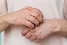 Kata Siapa Vaksin Campak-Rubella Nggak Aman? Prof. Hartono Kasih Penjelasan Tegas