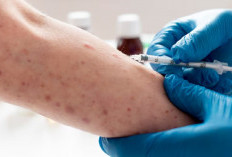 Virus Monkeypox Jadi Ancaman Dunia, WHO Sebut Cacar Monyet Berstatus 'Darurat Kesehatan Global'